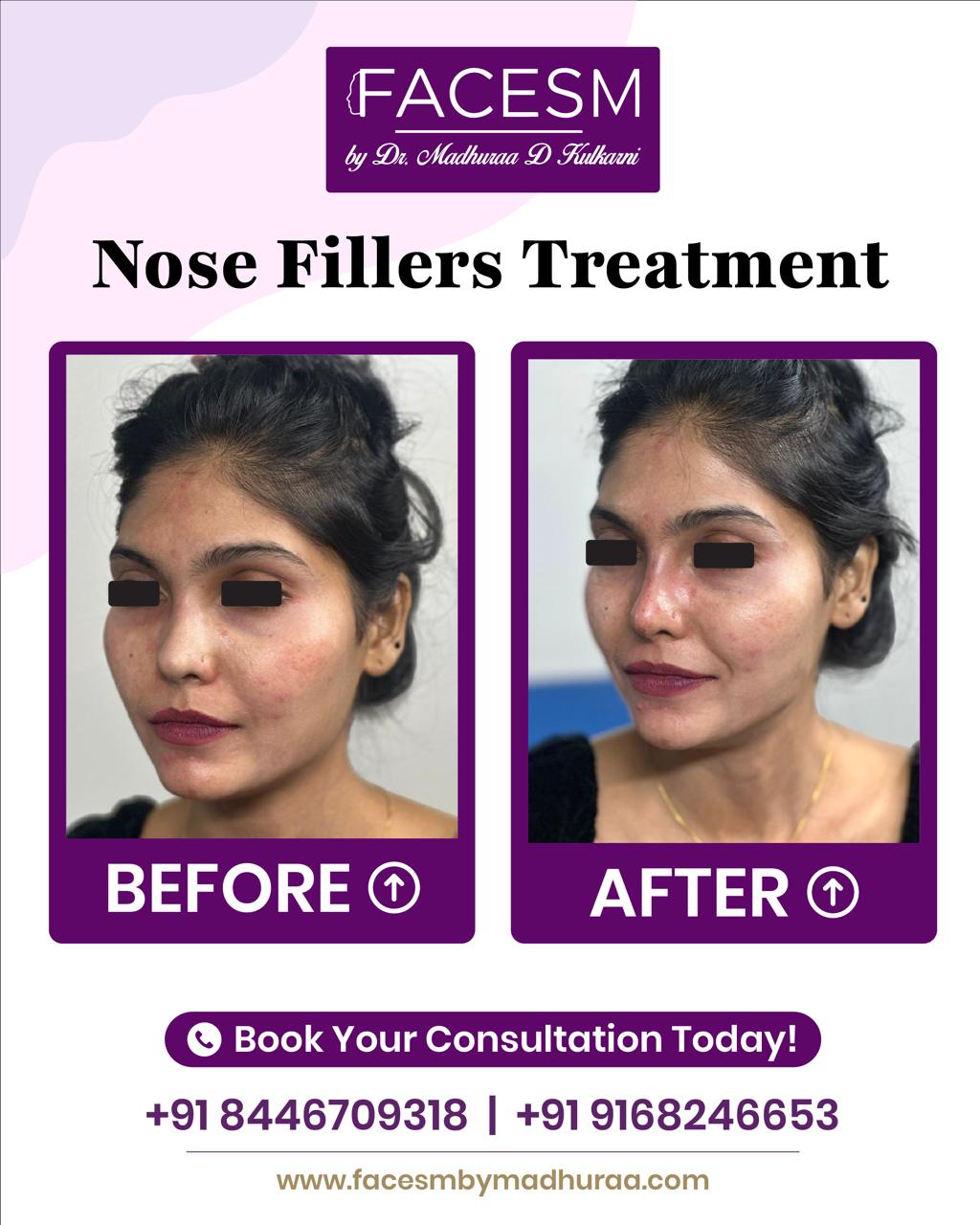 Nose Filler Before After