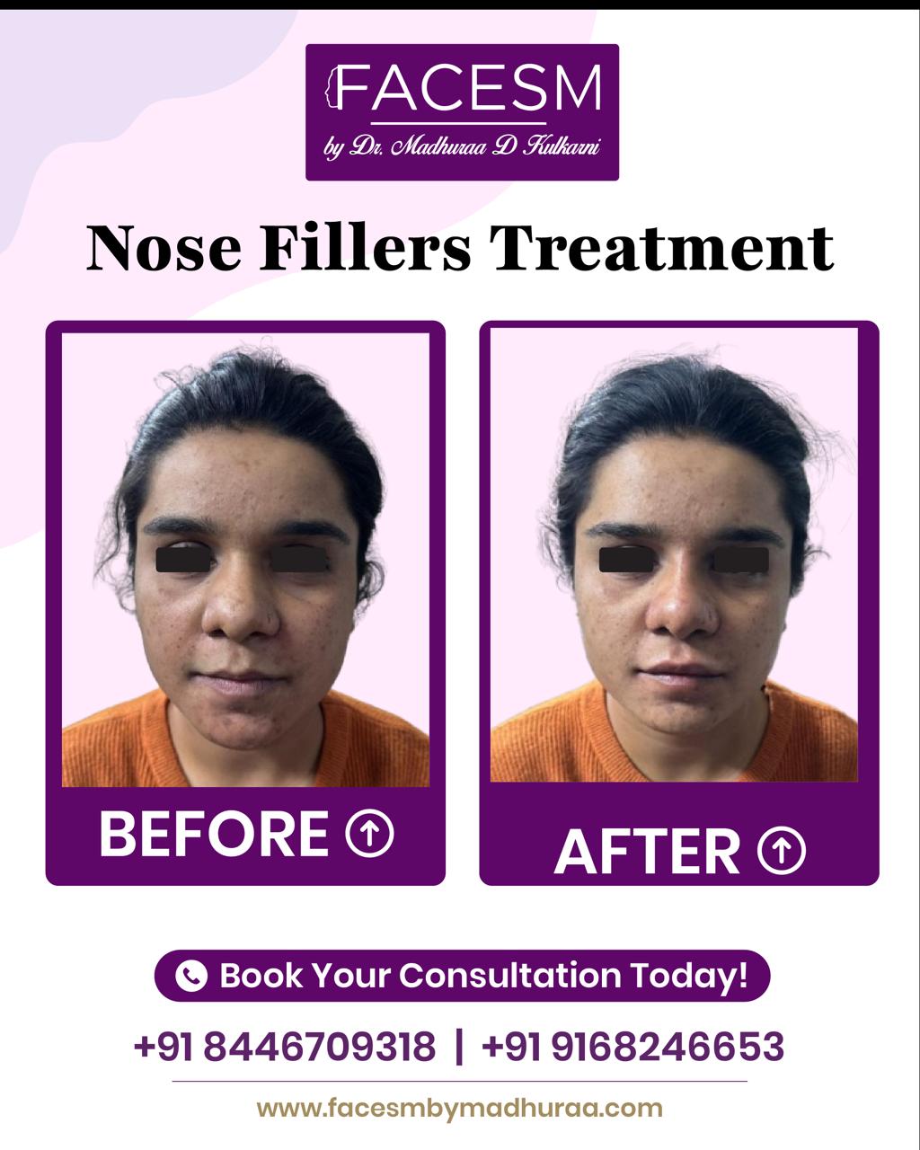 Nose Filler Before After
