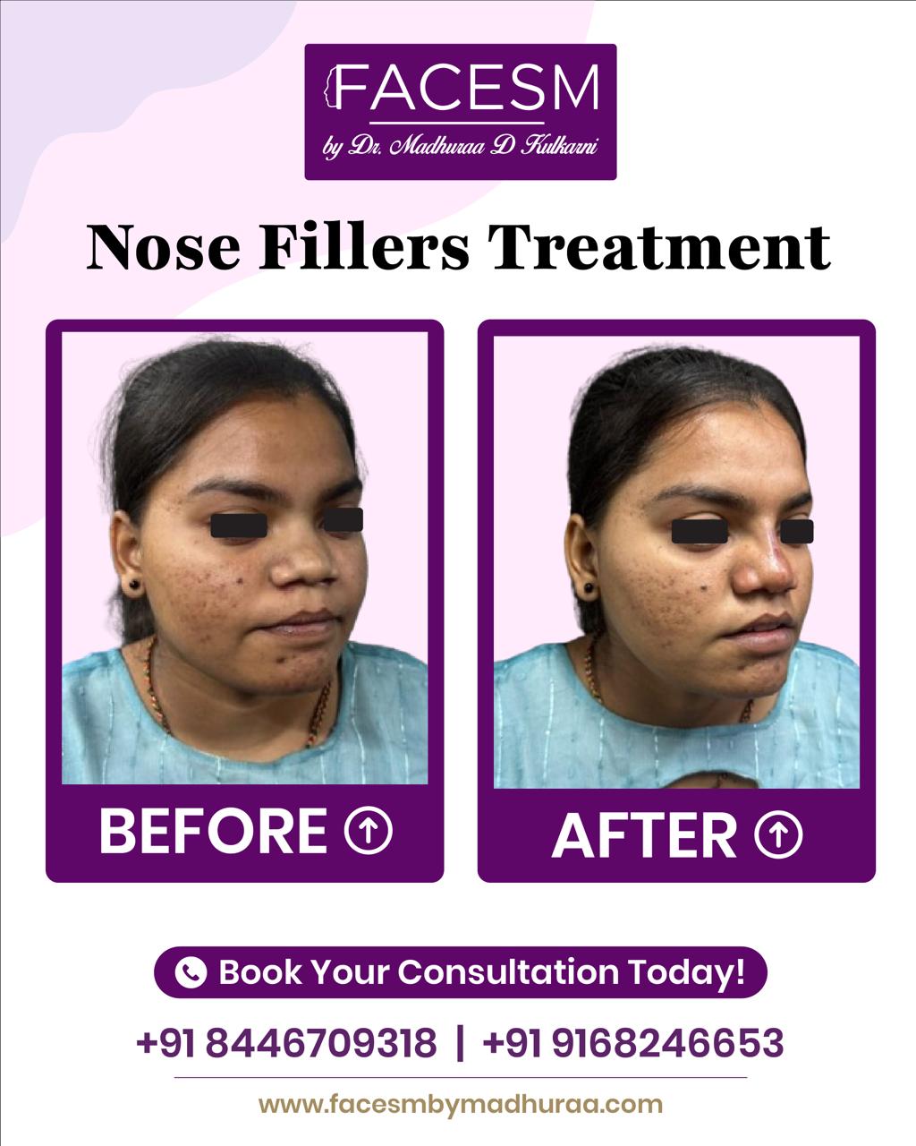 Nose Filler Before After