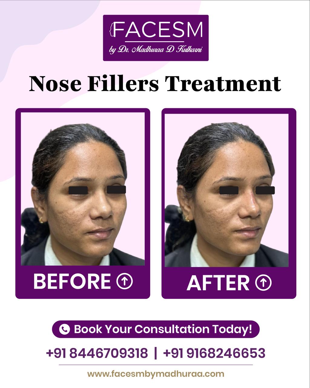 Nose Filler Before After