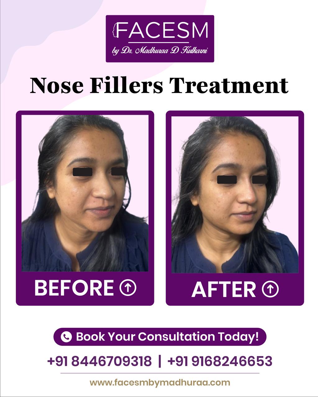 Nose Filler Before After